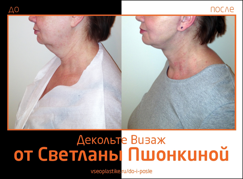 До и после омоложения «Декольте Визаж» у Светланы Пшонкиной