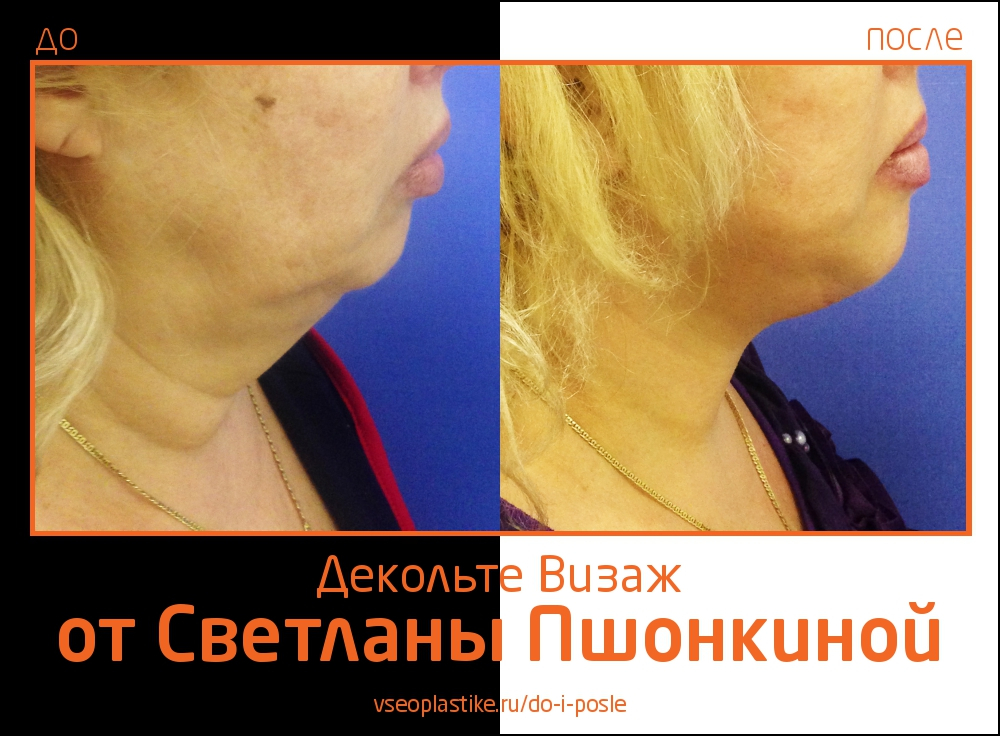 До и после омоложения «Декольте Визаж» у Светланы Пшонкиной