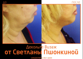 До и после омоложения «Декольте Визаж» у Светланы Пшонкиной