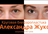 До и после круговой блефаропластики у Александра Жукова