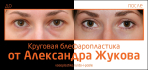До и после круговой блефаропластики у Александра Жукова