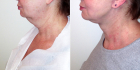 Омоложение шеи по методике «Декольте Визаж» у Светланы Пшонкиной