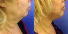 Омоложение шеи по методике «Декольте Визаж» у Светланы Пшонкиной