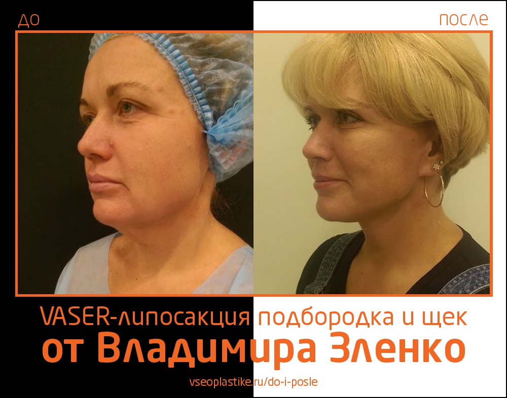 Vaser-липосакция подбородка и щек от Владимира Зленко