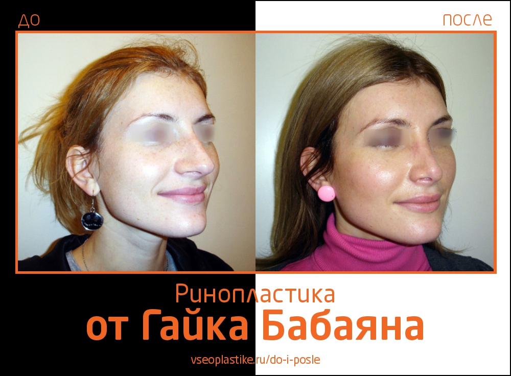 Фото до и после ринопластики у Гайка Бабаяна