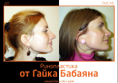 Фото до и после ринопластики у Гайка Бабаяна