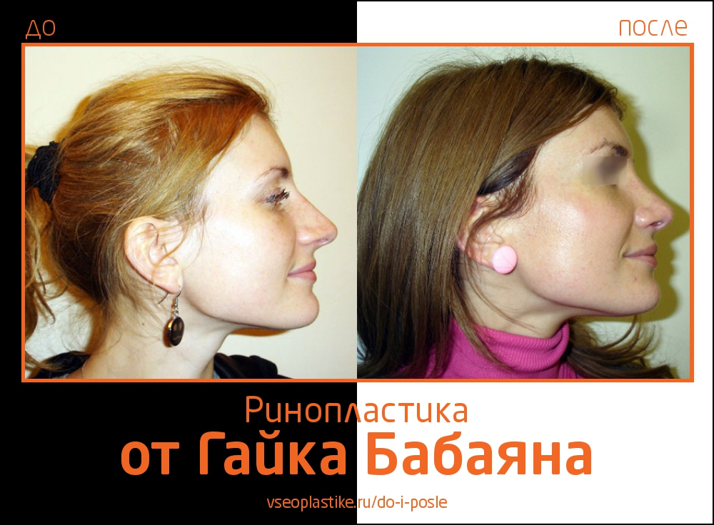 Фото до и после ринопластики у Гайка Бабаяна
