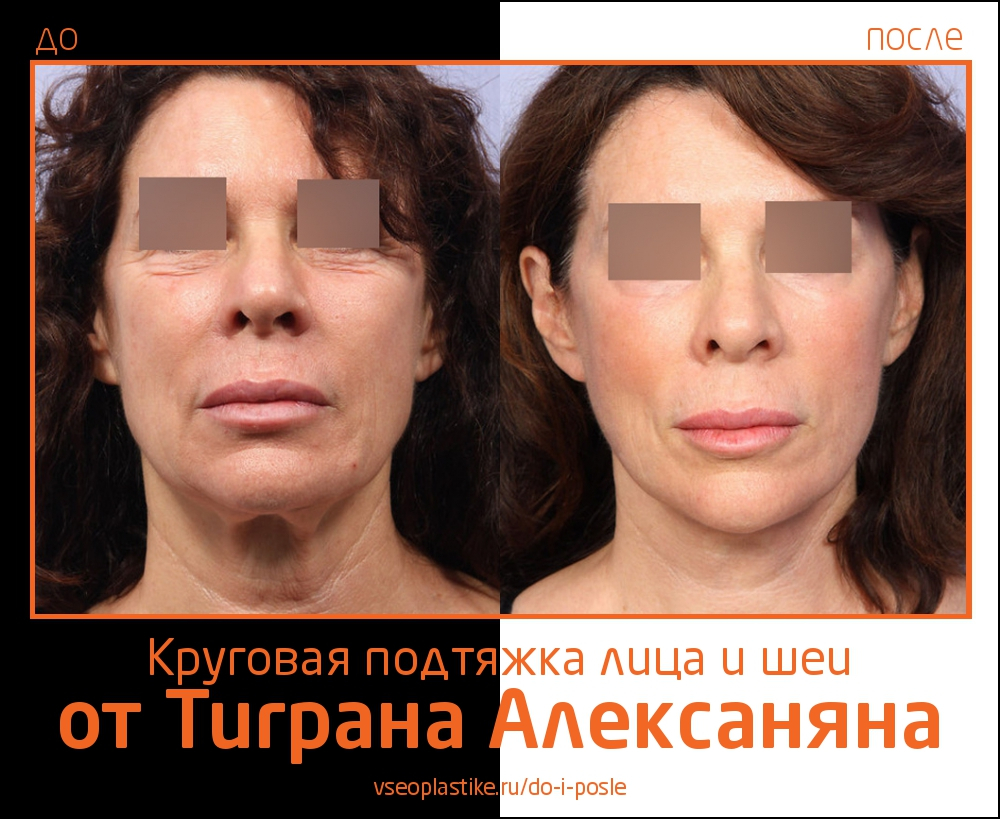 Круговая подтяжка лица и шеи и пластика век от Тиграна Алексаняна