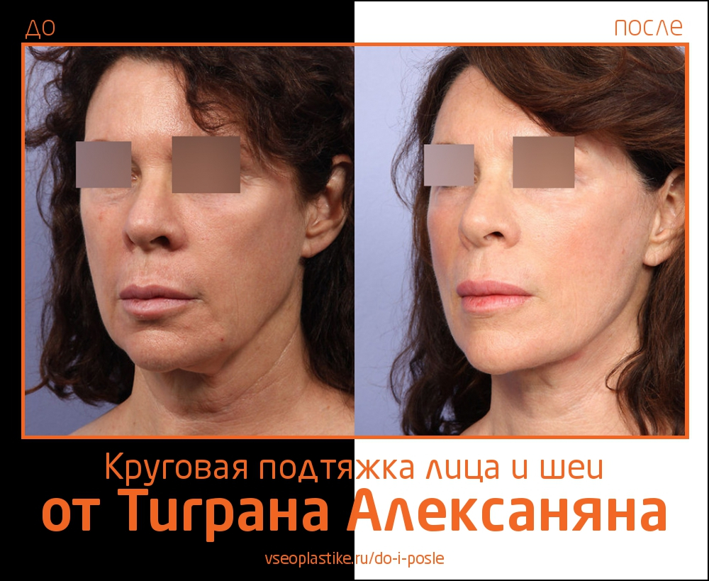 Круговая подтяжка лица и шеи и пластика век от Тиграна Алексаняна