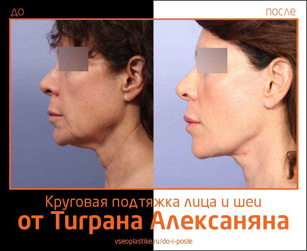 Круговая подтяжка лица и шеи и пластика век от Тиграна Алексаняна