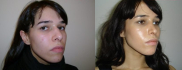 Пациентка Гайка Бабаяна до и после ринопластики