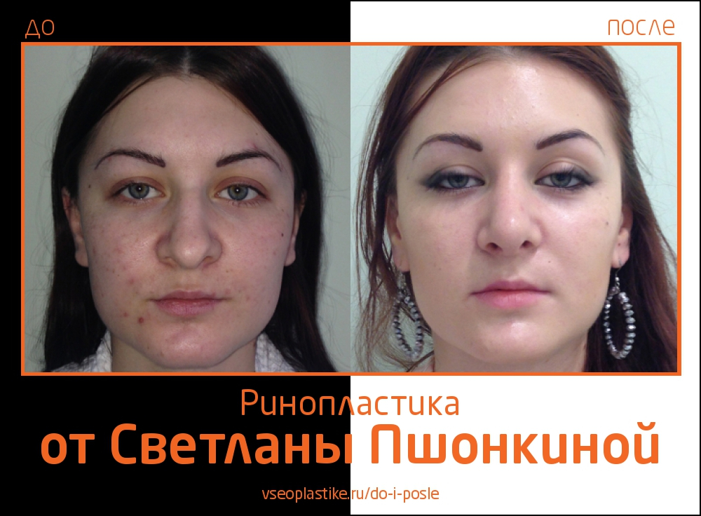 До и после ринопластики у Светланы Пшонкиной