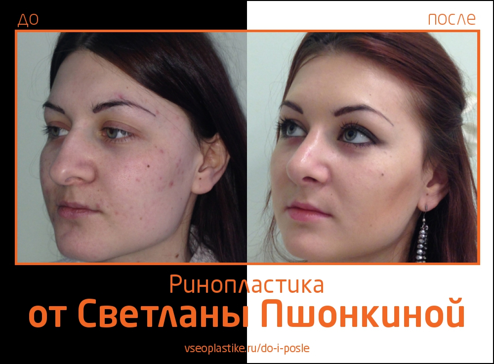 До и после ринопластики у Светланы Пшонкиной