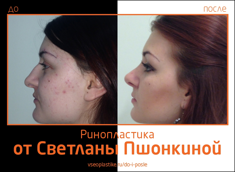 До и после ринопластики у Светланы Пшонкиной