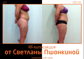 До и после RF-липосакции у Светланы Пшонкиной