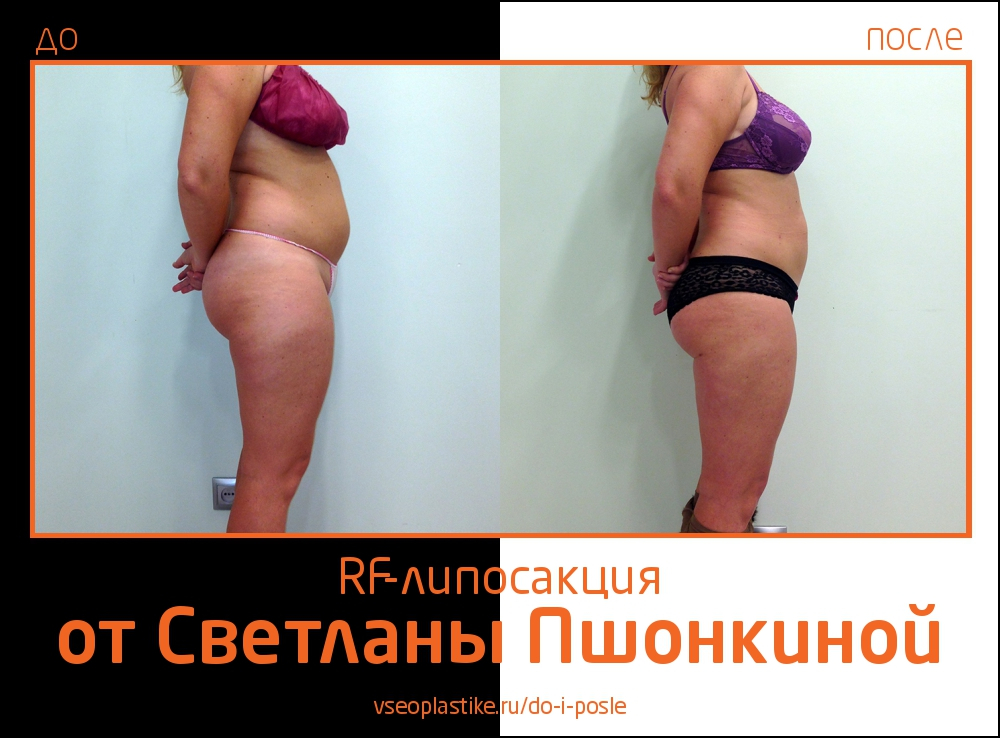 До и после RF-липосакции у Светланы Пшонкиной