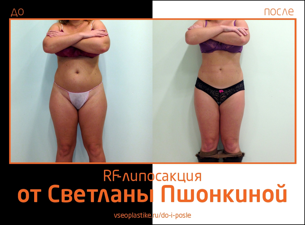 До и после RF-липосакции у Светланы Пшонкиной