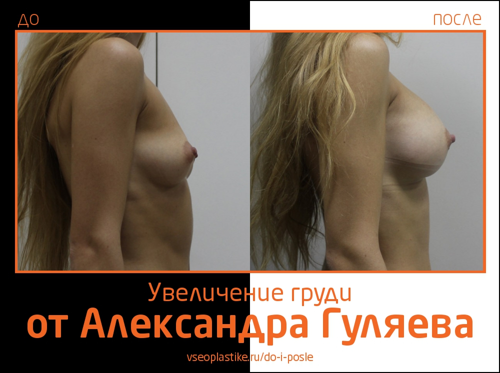 До и после увеличения груди у Александра Гуляева