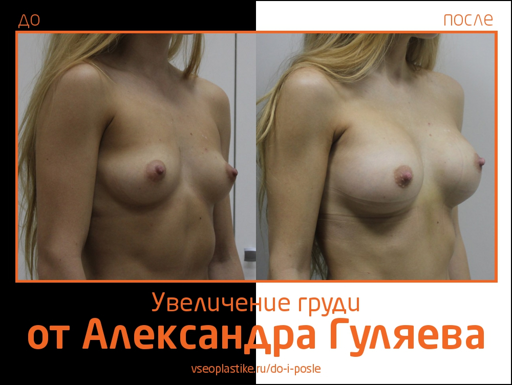 До и после увеличения груди у Александра Гуляева