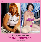 Роза Сябитова до и после абдоминопластики