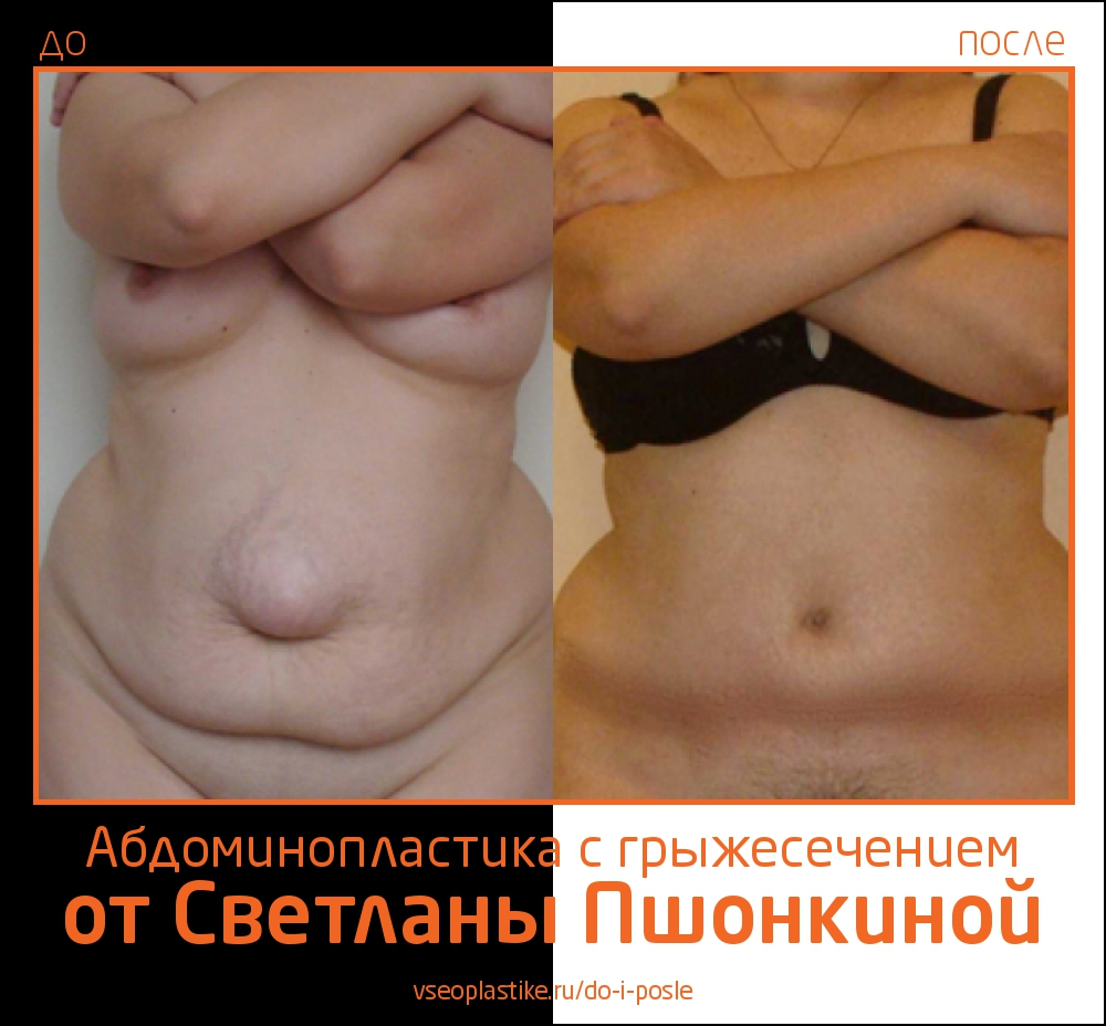 До и после абдоминопластики и грыжесечения у Светланы Пшонкиной