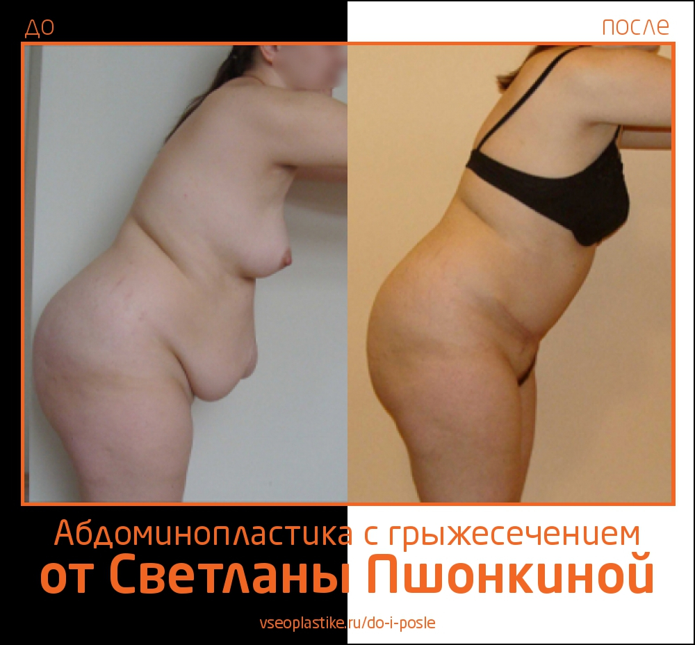 До и после абдоминопластики и грыжесечения у Светланы Пшонкиной