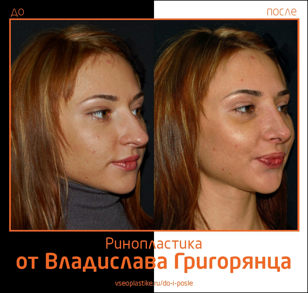 До и после ринопластики у Воладислава Григорянца