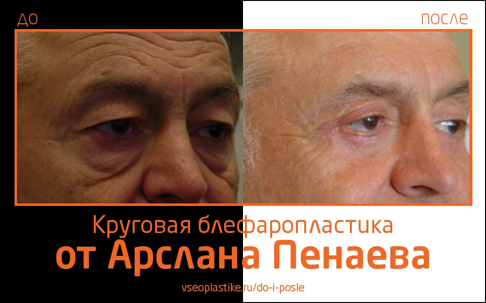 До и после круговой блефаропластики у Арслана Пенаева