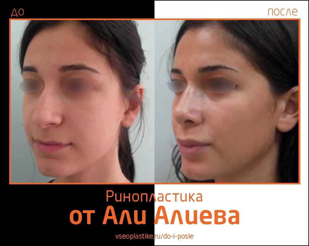 До и после ринопластики у Али Алиева