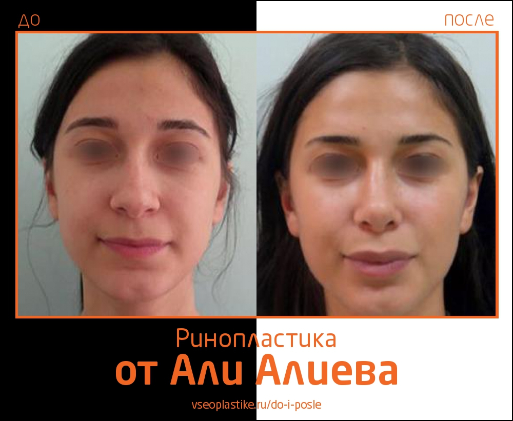 До и после ринопластики у Али Алиева