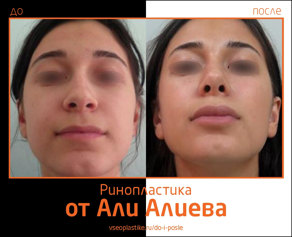 До и после ринопластики у Али Алиева