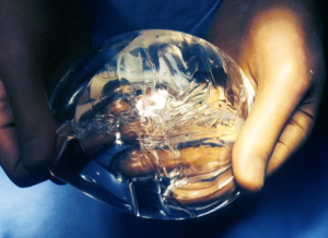 Солевой имплант