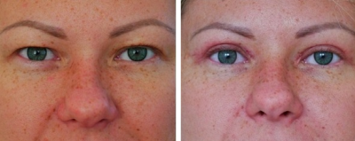 Верхняя блефаропластика у пластического хирурга Екатерины Вакориной