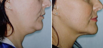 Фото до и после липосакции подбородка у Алексея Гварамии