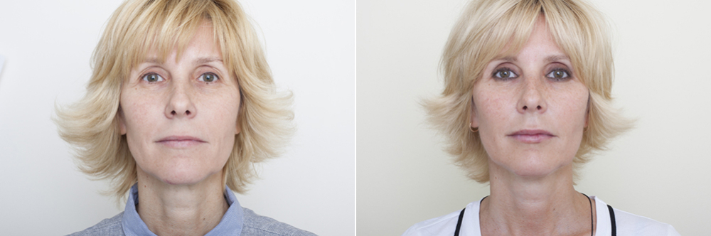 Олег Солдатов. Пациентка до и после подтяжки лица нитями
