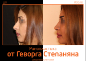 Геворг Степанян. Фото до и после ринопластики