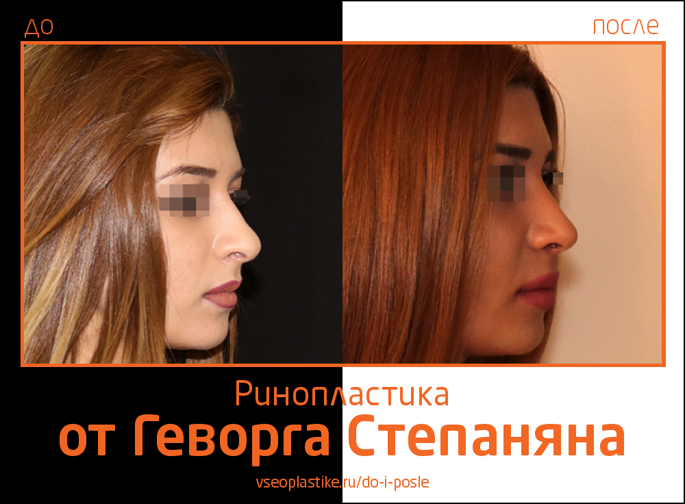 Геворг Степанян. Фото до и после ринопластики