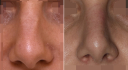 Нос до и после ринопластики у доктора Соломона Абрамяна