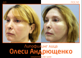 До и после липофилинга лица у Олеси Андрющенко