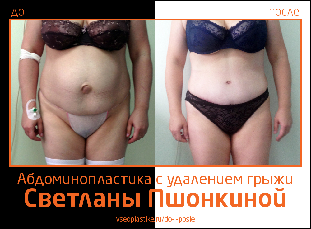 Фото до и после абдоминопластики с удалением грыжи у пластического хирурга Светланы Пшонкиной