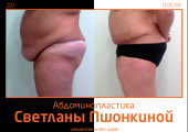 Фото до и после абдоминопластики у пластического хирурга Светланы Пшонкиной