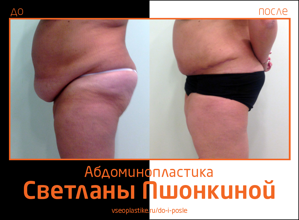 Фотографии до и после абдоминопластики у пластического хирурга Светланы Пшонкиной