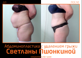 Фото до и после абдоминопластики с удалением грыжи у пластического хирурга Светланы Пшонкиной