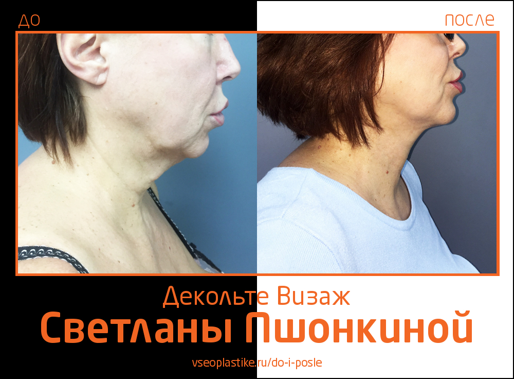  Фото до и после подтяжки шеи Декольте Визаж  у пластического хирурга Светланы Пшонкиной .