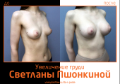 Фото до и после увеличения груди Ideal Breast у пластического хирурга Светланы Пшонкиной