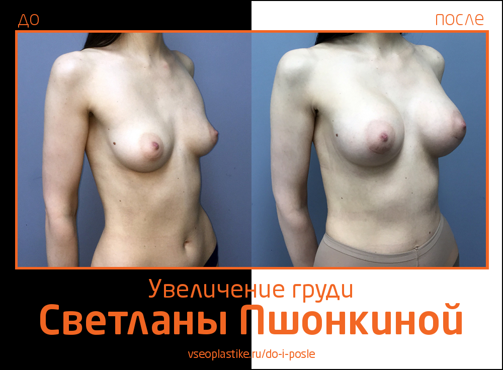 Фото до и после увеличения груди Ideal Breast у пластического хирурга Светланы Пшонкиной