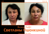 Фото до и после омоложения Визаж Лифт у пластического хирурга Светланы Пшонкиной