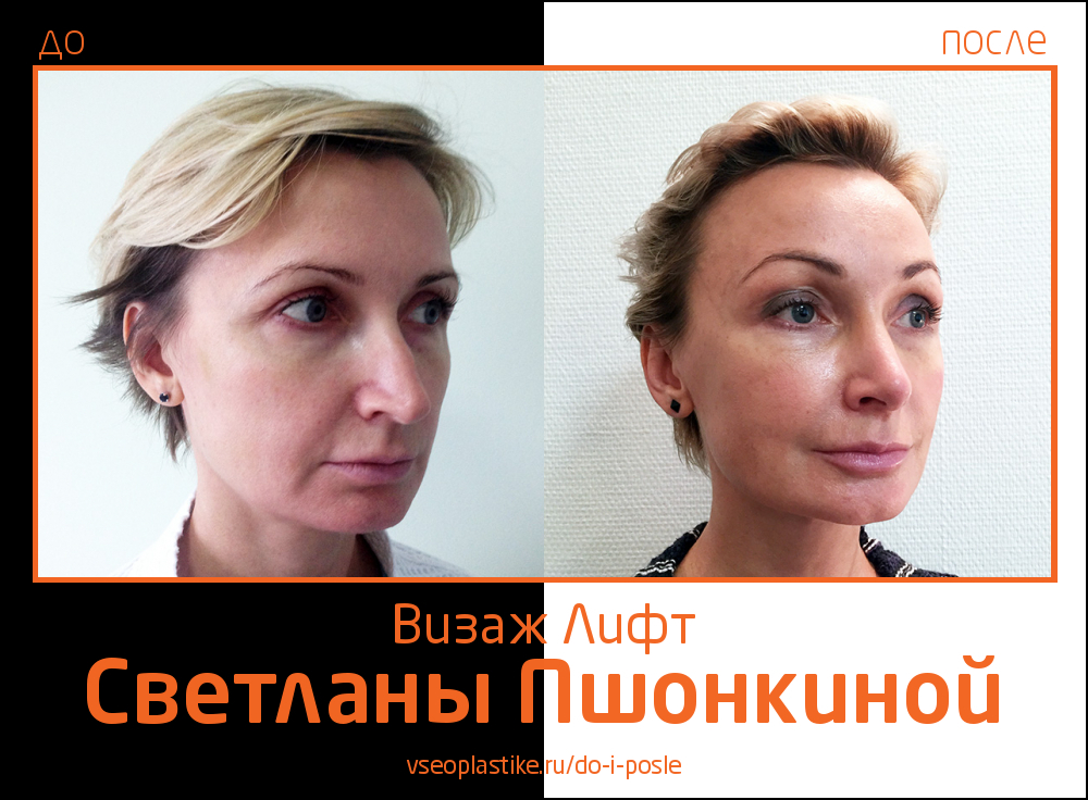 Фото до и после омоложения «Визаж Лифт» у пластического хирурга Светланы Пшонкиной