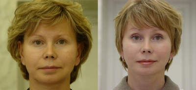 Смас-лифтинг у Валерия Якимца