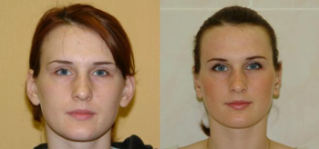 Фото до и после отопластики у пластического хирурга Татьяны Иванченковой